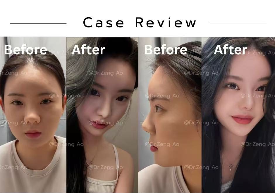 revision-rhinoplasty-case-4