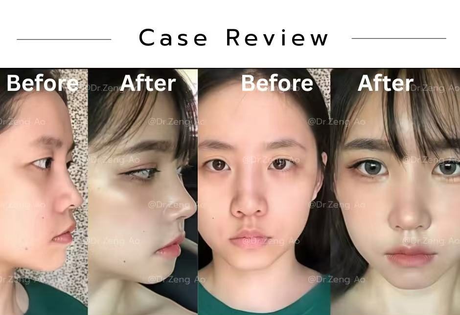 revision-rhinoplasty-case-5
