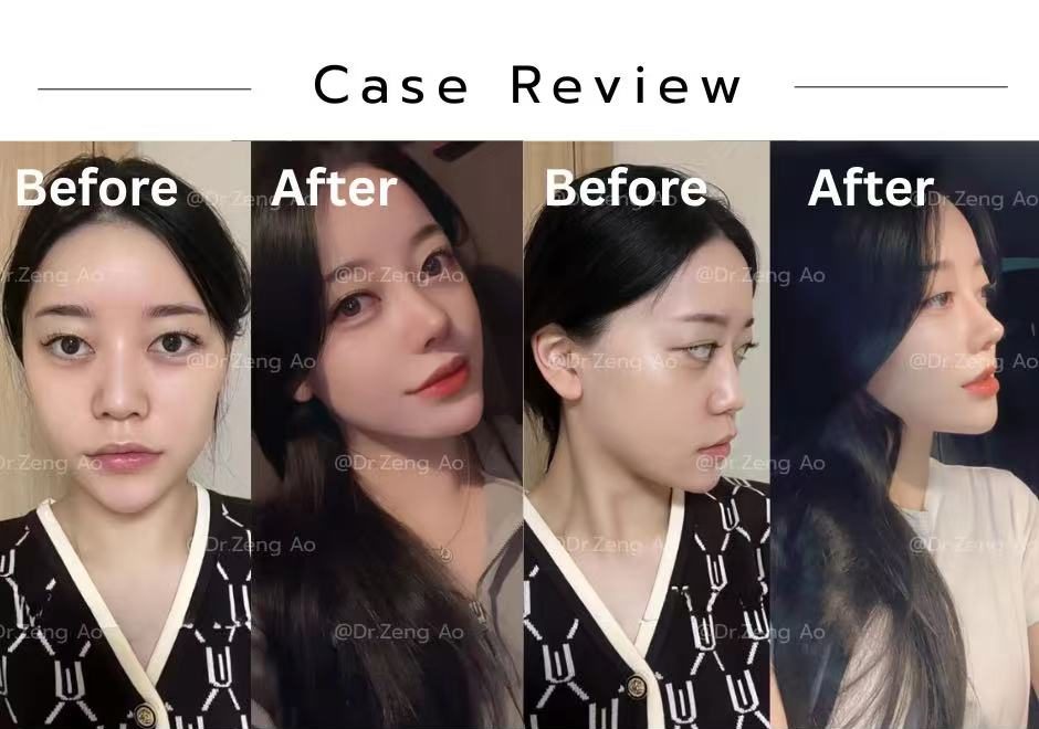 revision-rhinoplasty-case-6