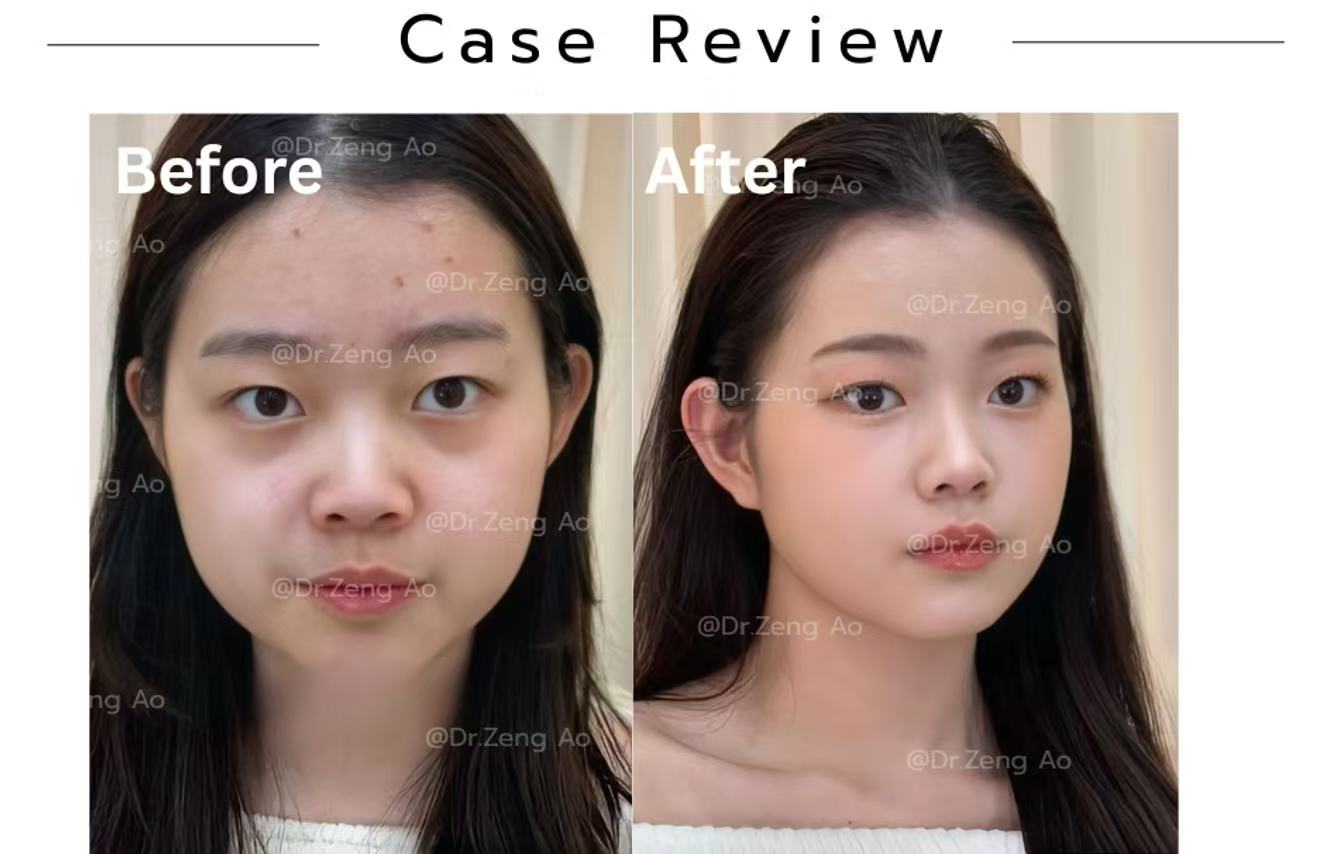 rhinoplasty-case-1